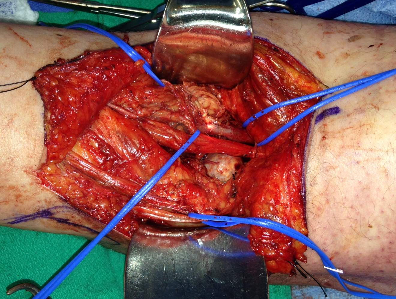 Posterior approach knee